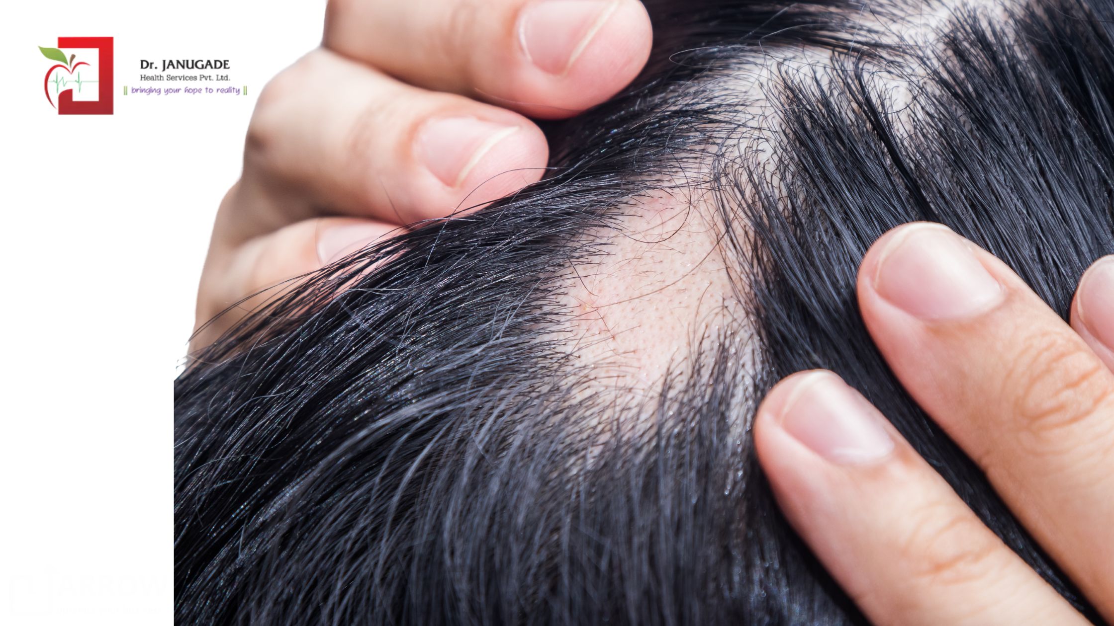 Alopecia Areata new research 2025